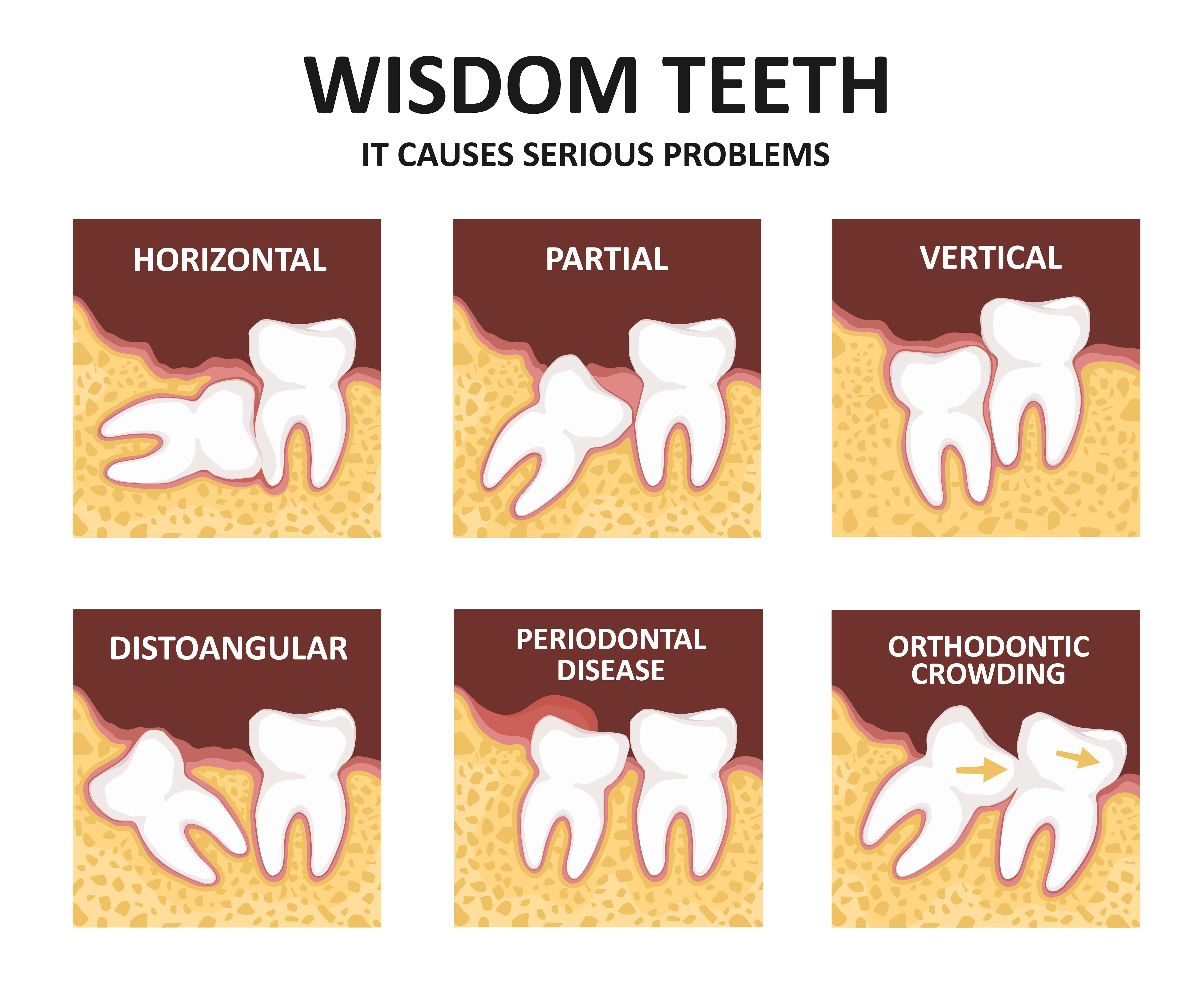 Post-Wisdom Tooth Removal Infection: Symptoms And Recovery